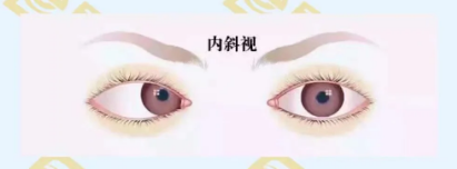 什么是調(diào)節(jié)性內(nèi)斜視？