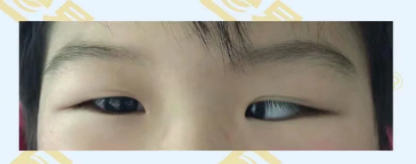 什么是先天性內(nèi)斜視？