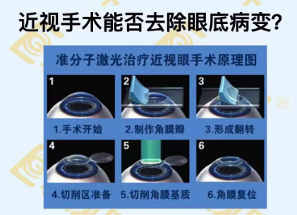 近視手術(shù)能否去除眼底病變？