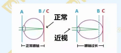 哪個年齡近視度數(shù)最容易增長？