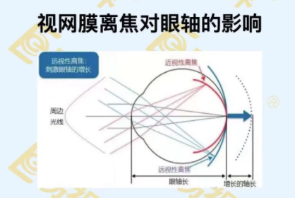 視網膜離焦對眼軸的影響