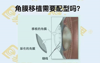 角膜移植需要配型嗎？