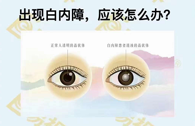 出現(xiàn)白內障應該怎么辦