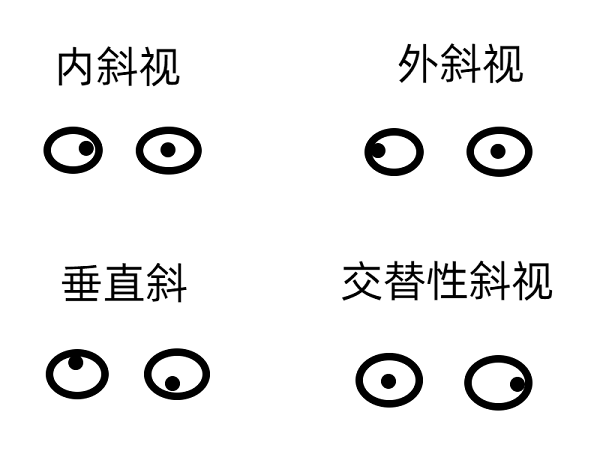 斜視早期的癥狀有哪些？